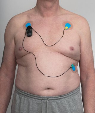 Bittium holter EKG monitörü. Sadece gri eşofman giyen beyaz bir erkeğin üzerine yerleştirilmiş üç yama elektrotlu.