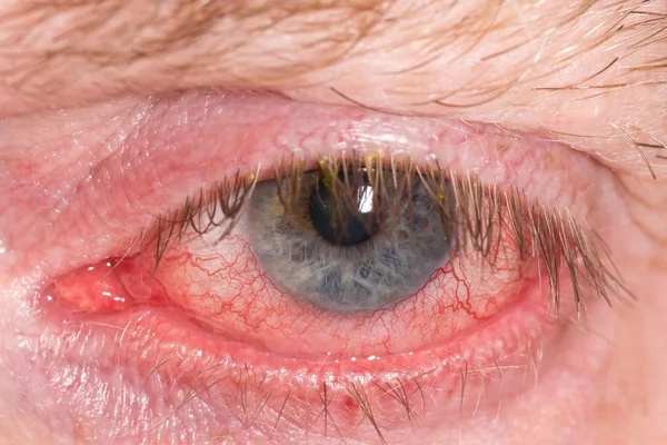 Červené podrážděné oči — Stock fotografie