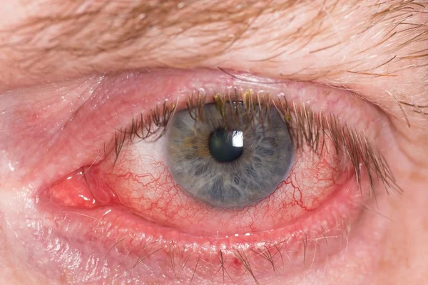 Red irritated eye — Stock Photo, Image