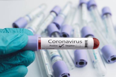 Yeni Coronavirus salgını teşhisi için pozitif COVID-19 testi ve laboratuvar örneği.
