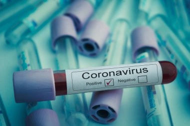 İzmir, Türkiye - 15 Nisan 2020: Coronavirus (COVID-19) tübü için yapılan kan testlerinde koronavirüs testi pozitif çıktı. Covid-19 konsepti.