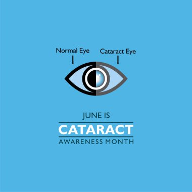 Vector illustration of Cataract Awareness Month observed in June, It is a dense, cloudy area that forms in the lens of the eye. clipart