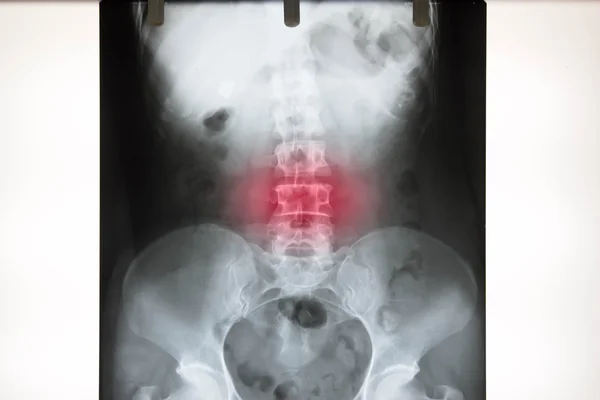 Röntgenfilm ryggraden skada Stockbild