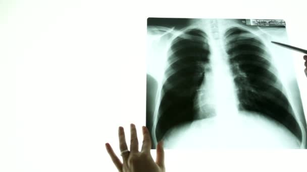 Крупним планом рука лікаря вказує на рентгенівське зображення легенів — стокове відео