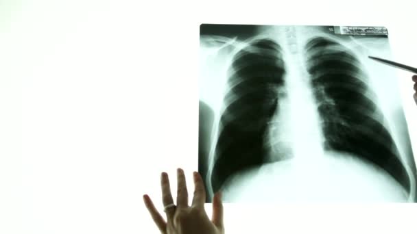 Close up doctor hand pointing on x-ray image of lungs — Stock Video