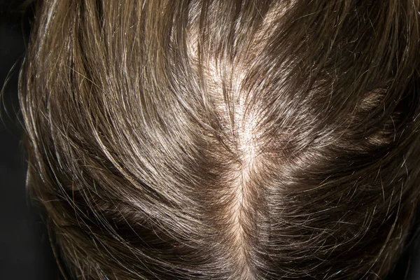 Thinning hair on head of woman. Top view a head of woman with hair loss.