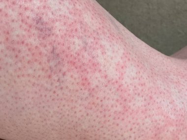 heat rash hives allergy reaction on knee close-up reference picture of blotchy mottled red skin erythema ab igne also known as EAI clipart
