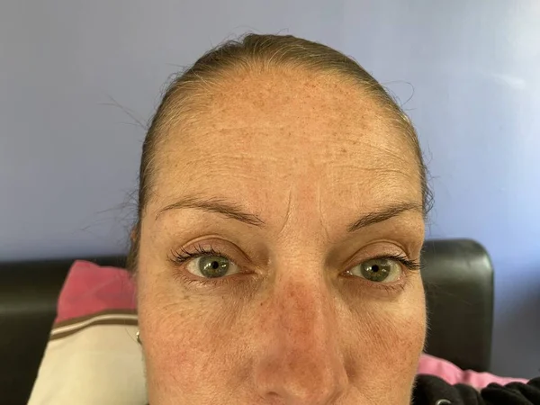 Face Woman Hyper Pigmentation Melasma Rare Addison Disease Also Known — Stock Photo, Image
