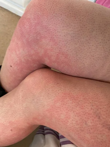 heat rash hives allergy reaction on knee close-up reference picture of blotchy mottled red skin erythema ab igne also known as EAI