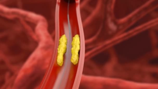 Procédure Angioplastie Coronarienne Peste Bloquant Flux Sanguin — Video
