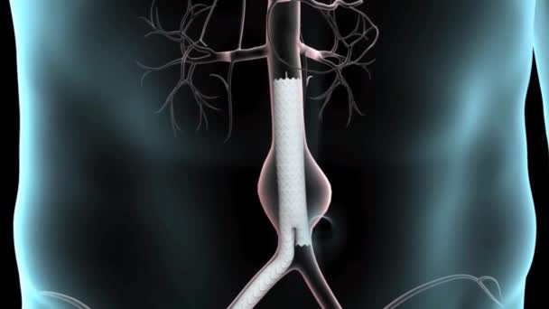 Large Abdominal Aortic Aneurysm Animation — Stock Video