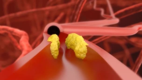 Koroner Anjiyoplasti Prosedürü Veba Kan Akışını Engelliyor — Stok video