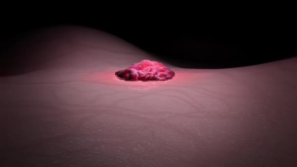 Gefäßmuttermale Bestehen Aus Blutgefäßen Die Sich Nicht Richtig Gebildet Haben — Stockvideo