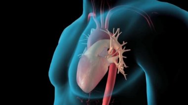 CTA tüm aort 3D görüntüleme görüntüsü aort anevrizması tespit etmek için ekranda dönüyor.