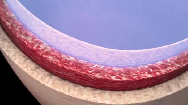 Coronary Reimplantation Ascending Aortic Aneurysm — Vídeo de Stock