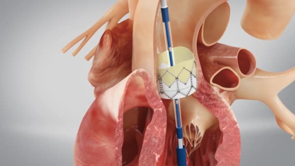 Cirugía Prótesis Aórtica Fijación Válvula Aórtica Artificial Corazón Modelo Humano — Vídeo de stock