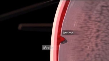 CTA ABDOMINAL AORTA Abdominal aort anevrizması buldu