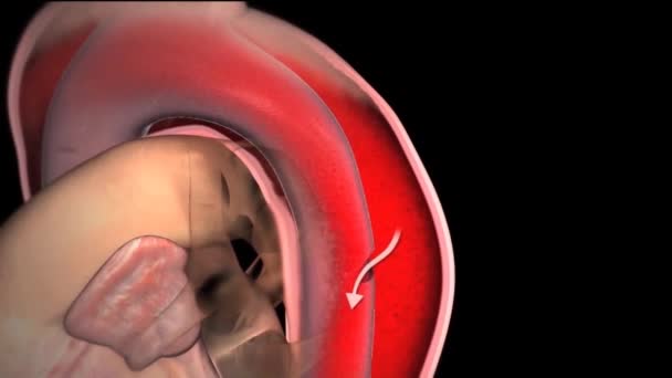 Cta Abdominal Aorta Findings Abdominal Aortic Aneurysm — 비디오