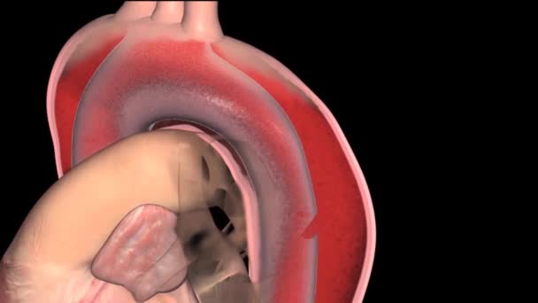 Cta Abdominal Aorta Abdominal Aort Anevrizması Buldu — Stok video