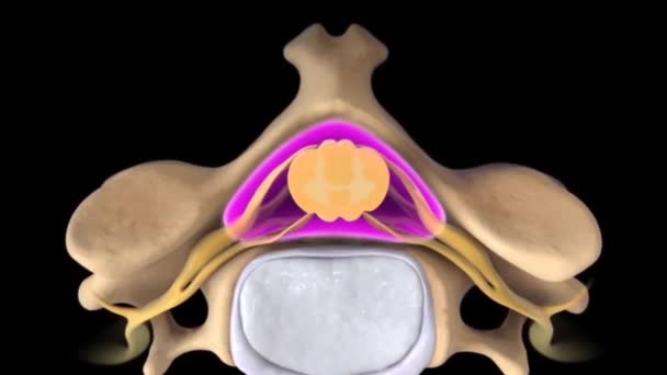 Pressione Sui Nervi Causa Dello Scivolamento Del Disco — Video Stock