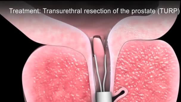 Benign Prostatic Hyperplasia Animation — Stock Video