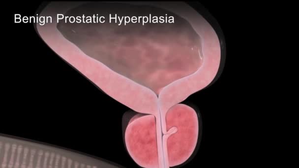 Benign Prostatische Hyperplasie Animatie — Stockvideo