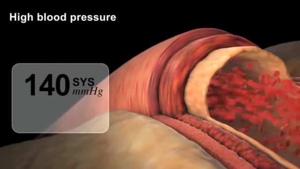 Анимация Высокого Кровяного Давления — стоковое видео