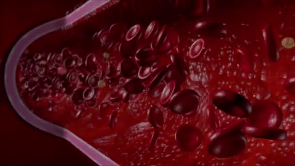 Athérosclérose Avec Sang Cholestérol Plaque Dans Les Vaisseaux Cause Maladie — Video
