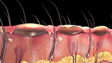 Birinci Derece Yanık Üst Derisi