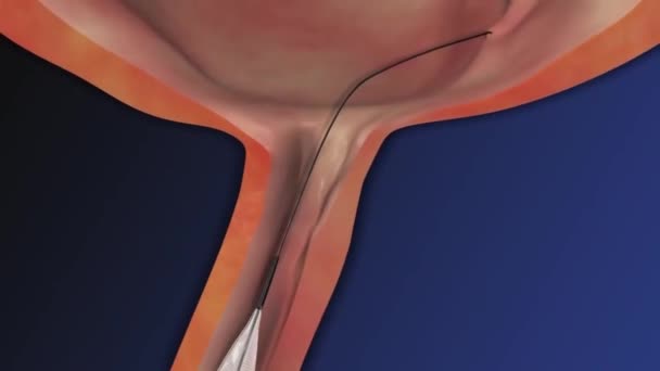 Litotripsia Procedimento Médico Usado Para Tratar Certos Tipos Pedras Nos — Vídeo de Stock