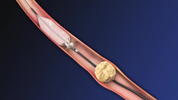 胆道结石是一种医疗程序 用于治疗某些类型的肾结石和其他器官中的结石 如胆囊或肝脏 — 图库视频影像