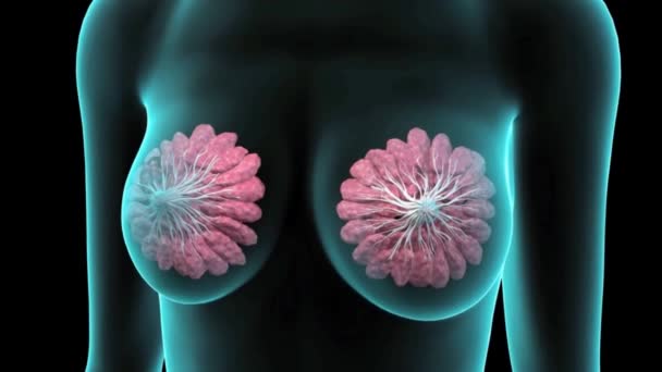 Kanker Payudara Anatomi Payudara Tumbuh Tumor Kanker Yang Terbentuk Dalam — Stok Video