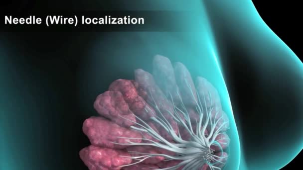 Ett Prov Tas För Att Undersöka Tumörbröstet Biopsi — Stockvideo