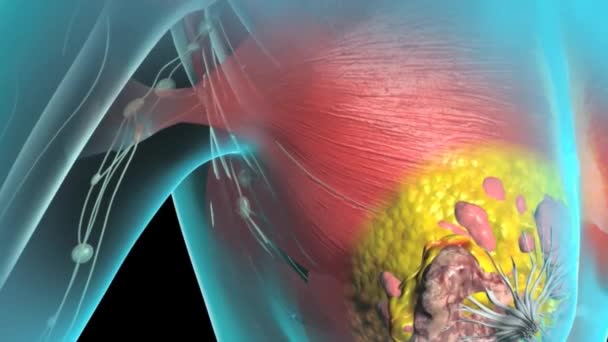 Cancro Mama Anatomia Mama Tumor Crescimento Câncer Que Forma Nas — Vídeo de Stock