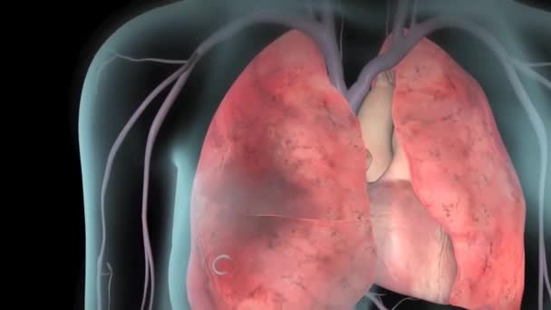 Blood Clot Lung — Stock Video