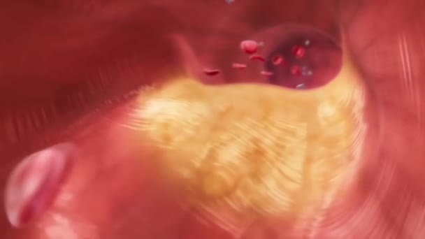 Trombosit Kolesterol Plağıyla Tıkanmış Arter Obezite Veya Diyet Beslenme Sorunları — Stok video