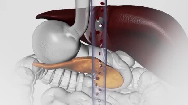 Diabete Disturbo Metabolico Causato Alti Livelli Zucchero Nel Sangue Rendono — Video Stock