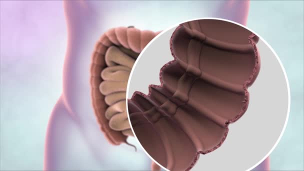 Animación Médicamente Precisa Del Cáncer Intestino — Vídeo de stock