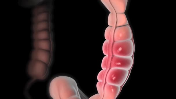 圧縮の結果として腸の一部の除去 — ストック動画