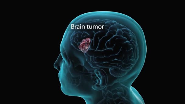Όγκος Στον Εγκέφαλο — Αρχείο Βίντεο