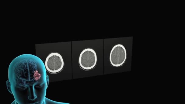 Nádor Nalezen Důsledku Tomografie Mozku — Stock video