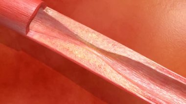 Hemoglobin hücreleri tıkanmış bir arterioskleroz hastalığına sebep olur. Tıkanık arteri stent takarak açıyorum.
