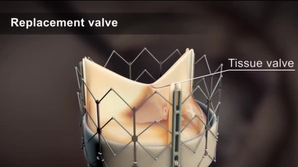 Inserta Una Válvula Cardíaca Artificial Lugar Una Válvula Cardíaca Disfuncional — Vídeos de Stock