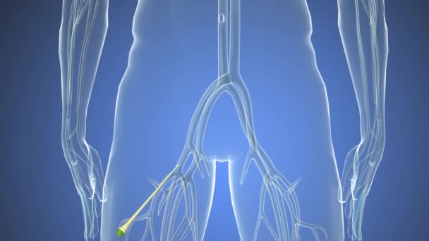 Hämoglobinzellen Die Durch Eine Verstopfte Arterie Fließen Und Arteriosklerose Verursachen — Stockvideo