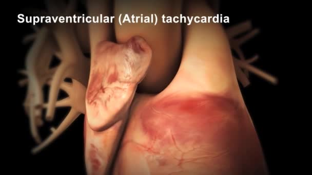 Pacemaker Tissue Located Right Atrium Heart Provides Output Normal Sinus — Stock Video