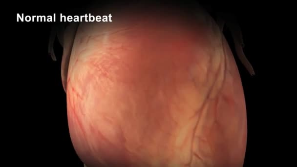 Fibrilación Ventricular Ritmo Inicial Más Común Paro Cardíaco Súbito — Vídeo de stock