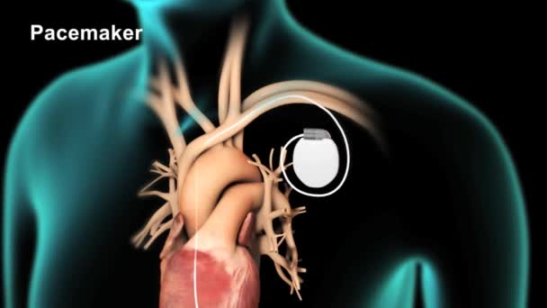 Pacemakers Zijn Geïnstalleerd Angio Katheter Laboratoria — Stockvideo
