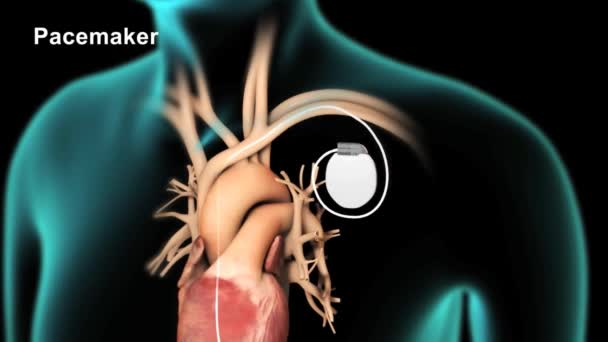 Marcapassos São Instalados Laboratórios Angio Cateter — Vídeo de Stock