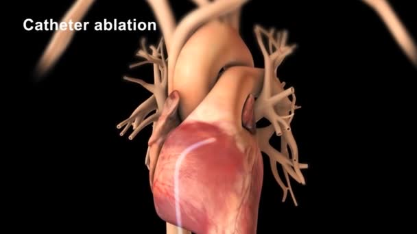 Ablación Por Catéter Tratamiento Arritmia Con Ondas Radio — Vídeo de stock