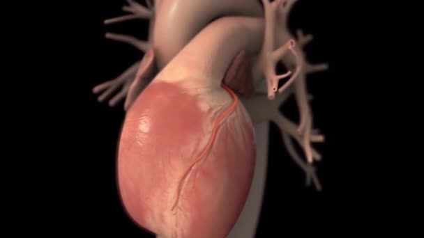Animazione Medica Della Malattia Dell Arteria Carotidea — Video Stock
